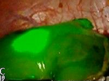 chirurgie laparoscopique - laparoscopische precisiechirurgie